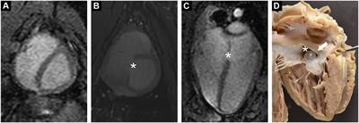 Pathology and Advanced Imaging—Characterization of a Congenital Cardiac Defect and Complex Hemodynamics in a Pig: A Case Report